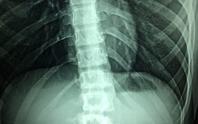 Spinal Cord Injury Lawsuits