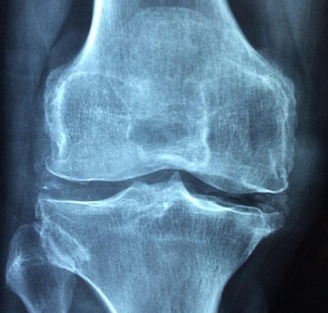 Common Causes of Knee Injuries at Work